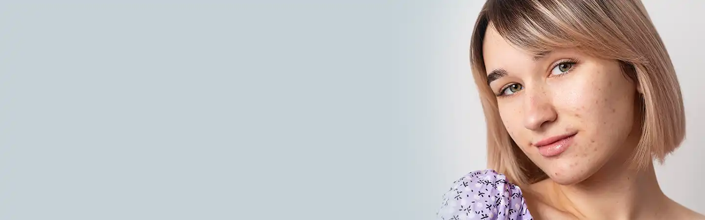 Acne Scar Reduction Treatment