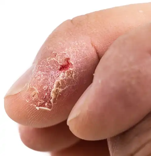 Ways to Prevent Fungal Infections