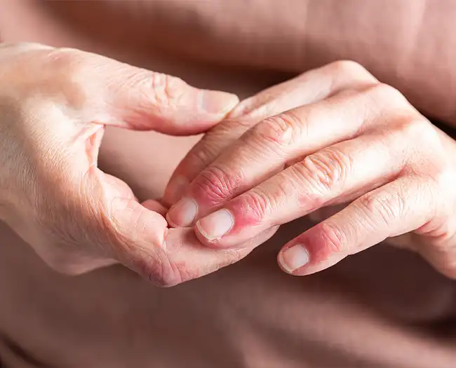 Eczema