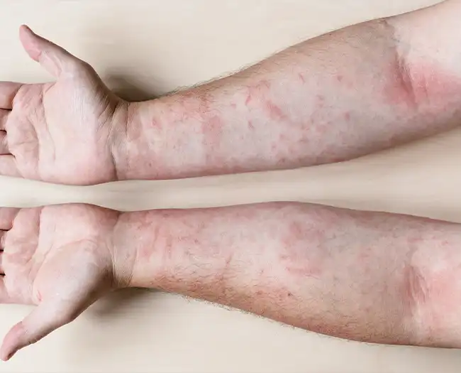 Psoriasis