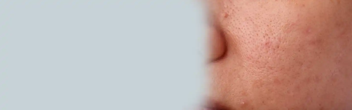Acne Scars