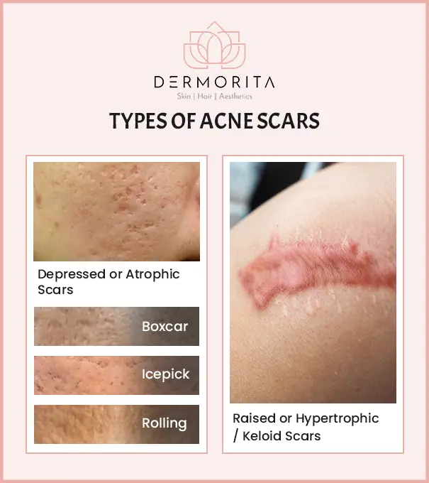 Types of Acne Scars Types of Acne Scars: Acne is broadly divided into two categories – Depressed or Atrophic Scars and Raised or Hypertrophic/ Keloid Scars. Boxcar, ice pick, and rolling acne scars are types of atrophic scars.