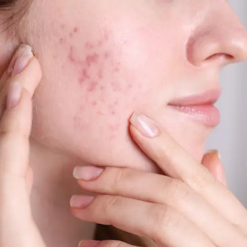Open Pores Treatment for Refined Skin Texture
