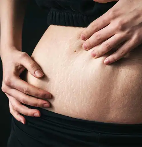 Stretch marks, a kind of permanent scars that develop due to rapid stretching or shrinking of the skin. appear on the hips, abdominal area, thighs, breasts, lower back, buttocks, and upper arms