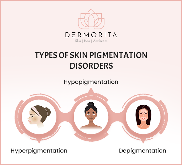 Types of Skin Pigmentation Disorders