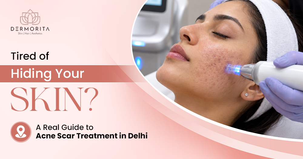 Tired of Hiding Your Skin? A Real Guide to Acne Scar Treatment in Delhi