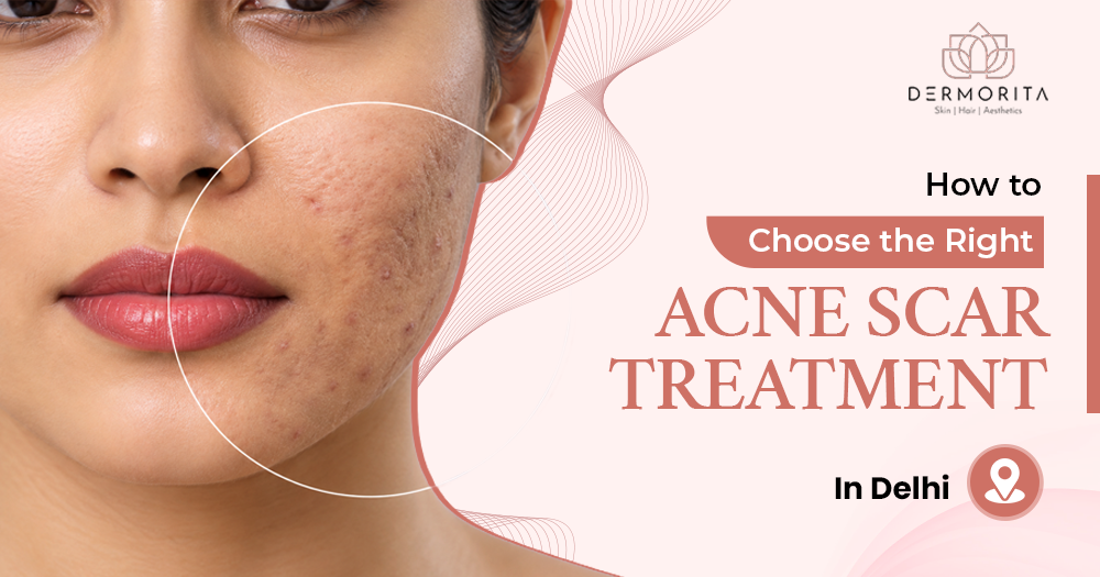 How to Choose the Right Acne Scar Treatment in South Delhi